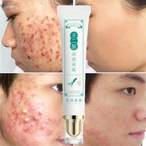 여드름크림 피부트러블 치료제 여드름흉터크림 청소년 성인용 스킨케어제