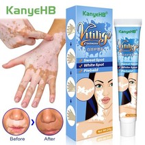 20g 허브 추출물 vitiligo 연고 제거 백선 흰 반점 제거 피부 흰 반점 백반증 치료 크림, 1개