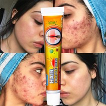 피부 가려움 연고 습진 모낭염 두피 건선연고 지루성피부염 치료, 1개, 20g