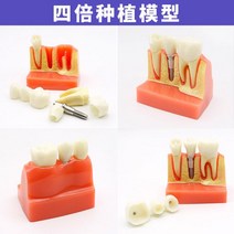 치아모형 덴티폼 모델 치아구조 이빨모형 치주질환, 4배 크기 임플란트 모델