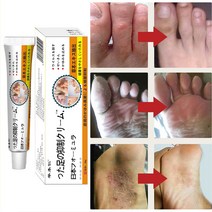 무좀약 연고 발톱 치료 발가락 가려움 연고 발냄새 제거, 20ml, 2개