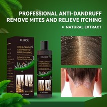 100ml 치료 샴푸 비듬 방지 가려움증 및 각질 두피 건선 출혈 피부염, [01] 100ml shampoo