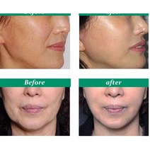 얼굴 리프팅 기계 마사지기 미용기기 입술 주사기 보톡스 필러 3D 조각 LED 조명 사인 소매 메디, 06 BOTOX Nabota100iu