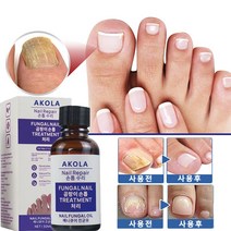 AKOLA 조갑사상균 손톱 리페어 에센스 발톱 무좀 처리 매니큐어 진균유 손톱 발톱 강화 30ml, 2개