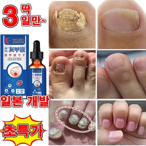 손톱 발톱 무좀 케어 앰플 발톱 영양제 발톱 관리 제거 문제성 발톱 100% 제거, 1개, 30ml