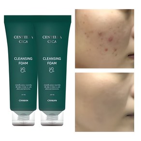 여드름 기능성 클렌징폼 좁쌀 아크네 사춘기 청소년 화장품 수부지 센텔라 시카 클렌저, 1+1 여드름 모공 피지 각질 제거 센텔라시카 폼클렌징, 120ml