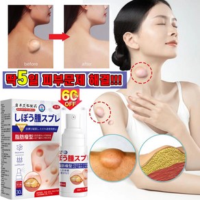 일보기술 피지낭종 제거 연고 피부 지방종 완화 크림, 30ml, 5개