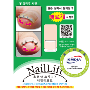 내성발톱 교정기기 네일리프트 NailLift, 1개, 프리사이즈