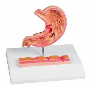 궤양이 있는 위 모형 / 축소 크기 모형 경궤양 위염 단계 섹션 모형 식도 하부 위 십이지장 비대성 위염 출혈성위염 / K217 / 독일 Ele Zimme 제품, 1개