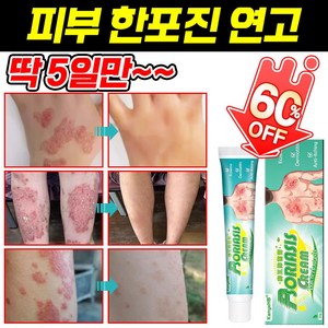 [빠른 배송] 피부 한포진 연고 습진 알레르기 제거 피부 사타구니 가려움증 건조 연고 발포 피부염 제거, 20ml, 5개