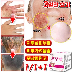 1/1+1 [즉효] 모낭염 연고 지루성피부염 피부가려움증 여드름 완화 크림, 2개, 30g