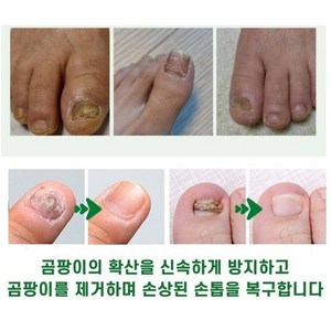 {일본 수입} 100% 두꺼운 손발톱 곰팡이 제거오래된 회색 손톱 제거기타 모든 손톱 트리트먼트 LY023, 1개, 20g