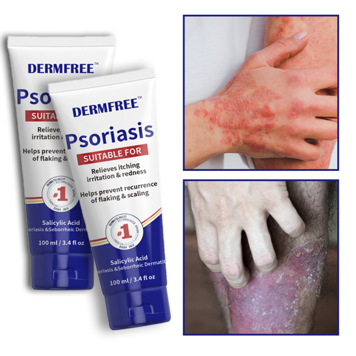 DERMFREE 건선 크림 습진 두드러기 피부염 두피건선 피부 가려움증
