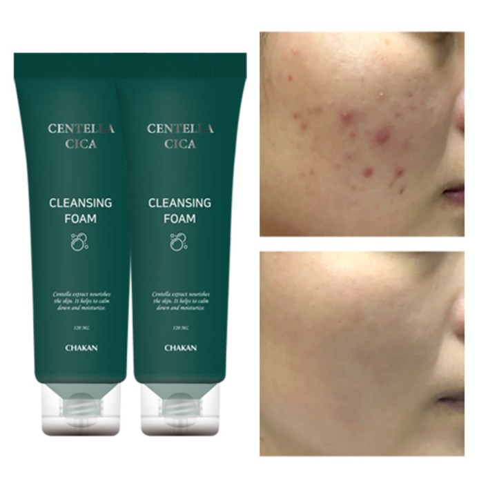 여드름 기능성 클렌징폼 좁쌀 아크네 사춘기 청소년 화장품 수부지 센텔라 시카 클렌저, 120ml, 2개